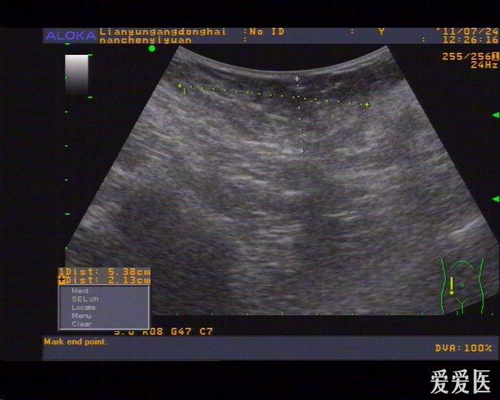 这是脂肪瘤还是副乳? - 超声医学讨论版 - 爱爱医医学论坛