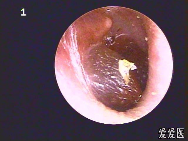 大疱鼓膜炎(图片)