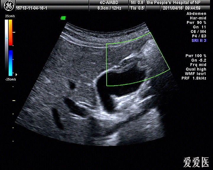 胆囊腺肌症可能,请指教 超声医学讨论版 爱爱医医学论坛
