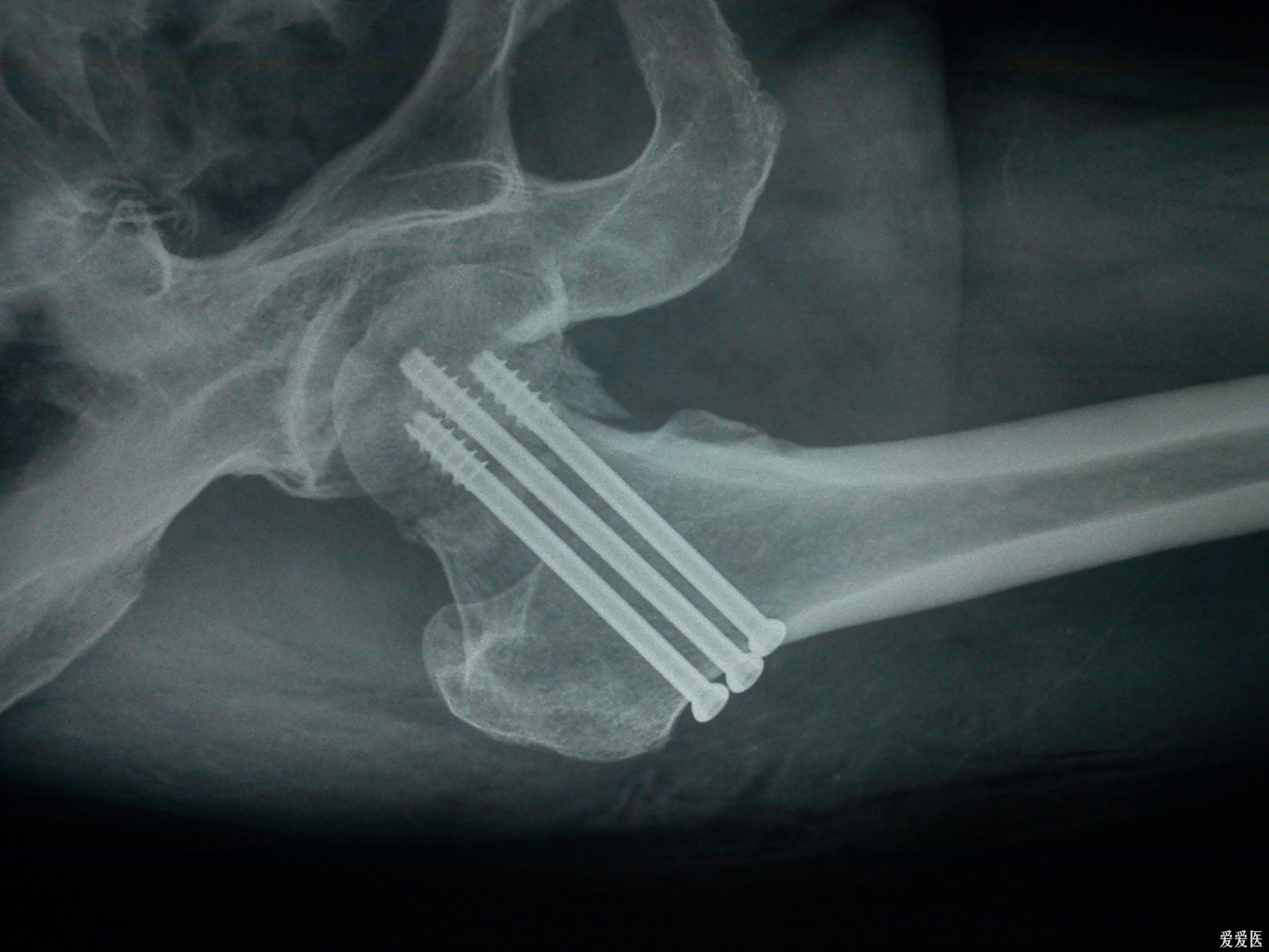 左侧股骨颈骨折（Garden4型）