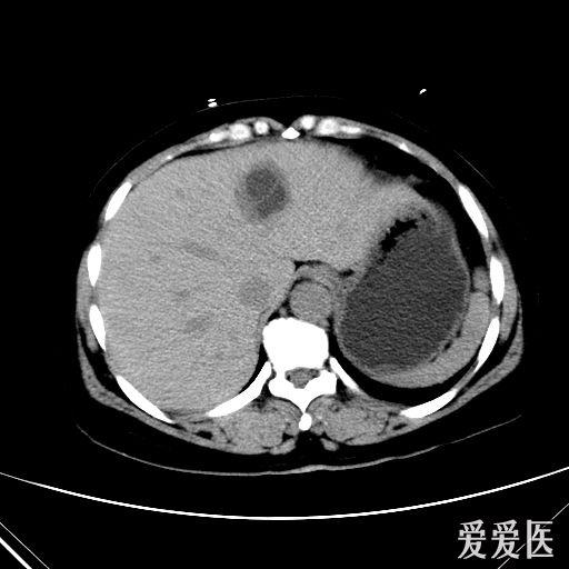 肝脏ct