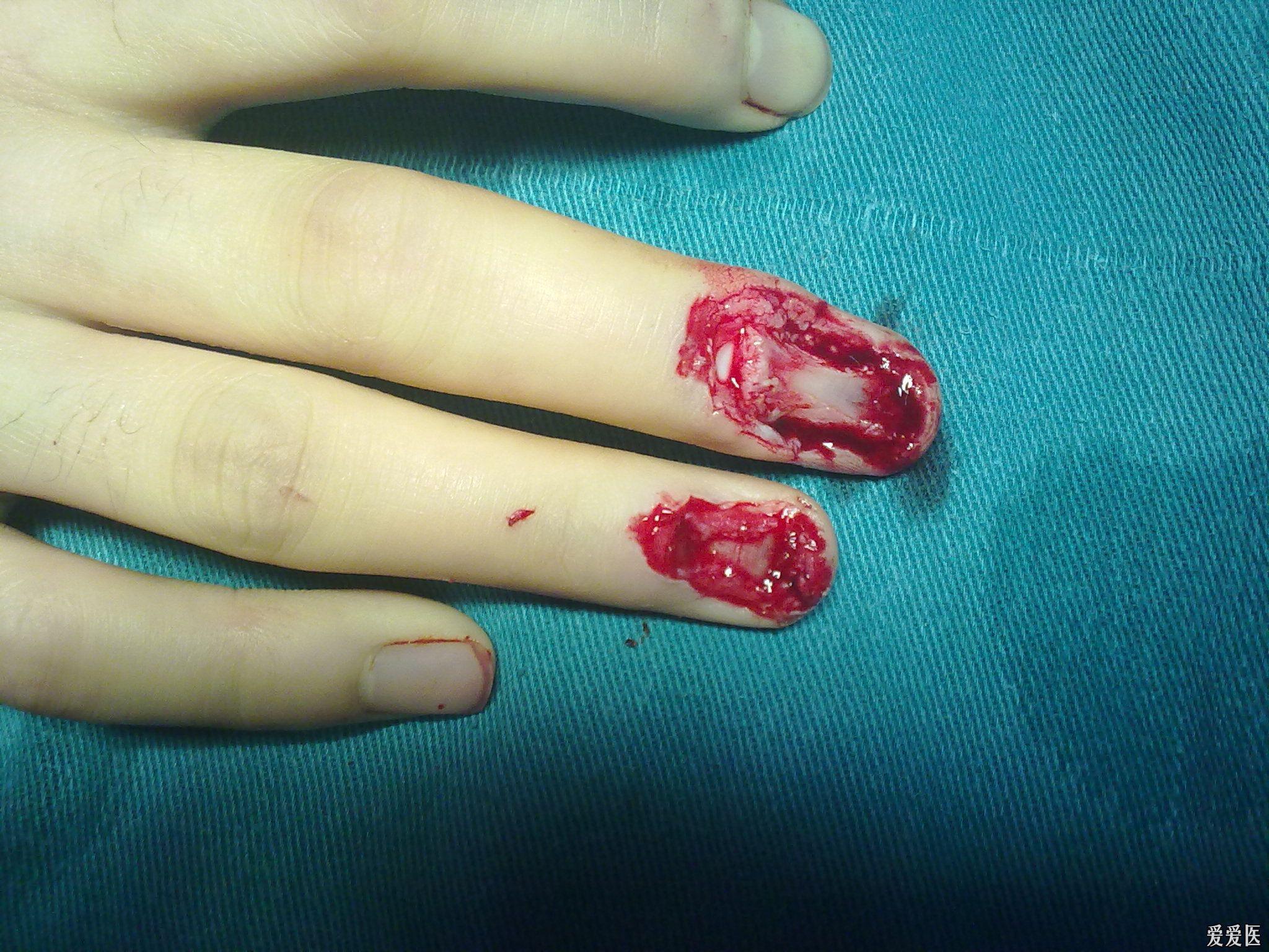 手指创面           患者中环指机器磨压伤致中指远指间关节背侧皮肤
