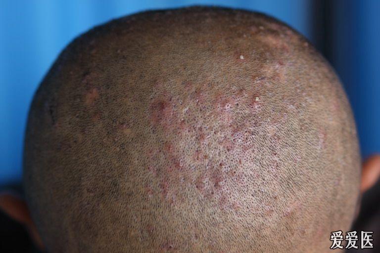 头皮反复起丘疹脓疱继而演化为结节瘢痕伴痒痛一年
