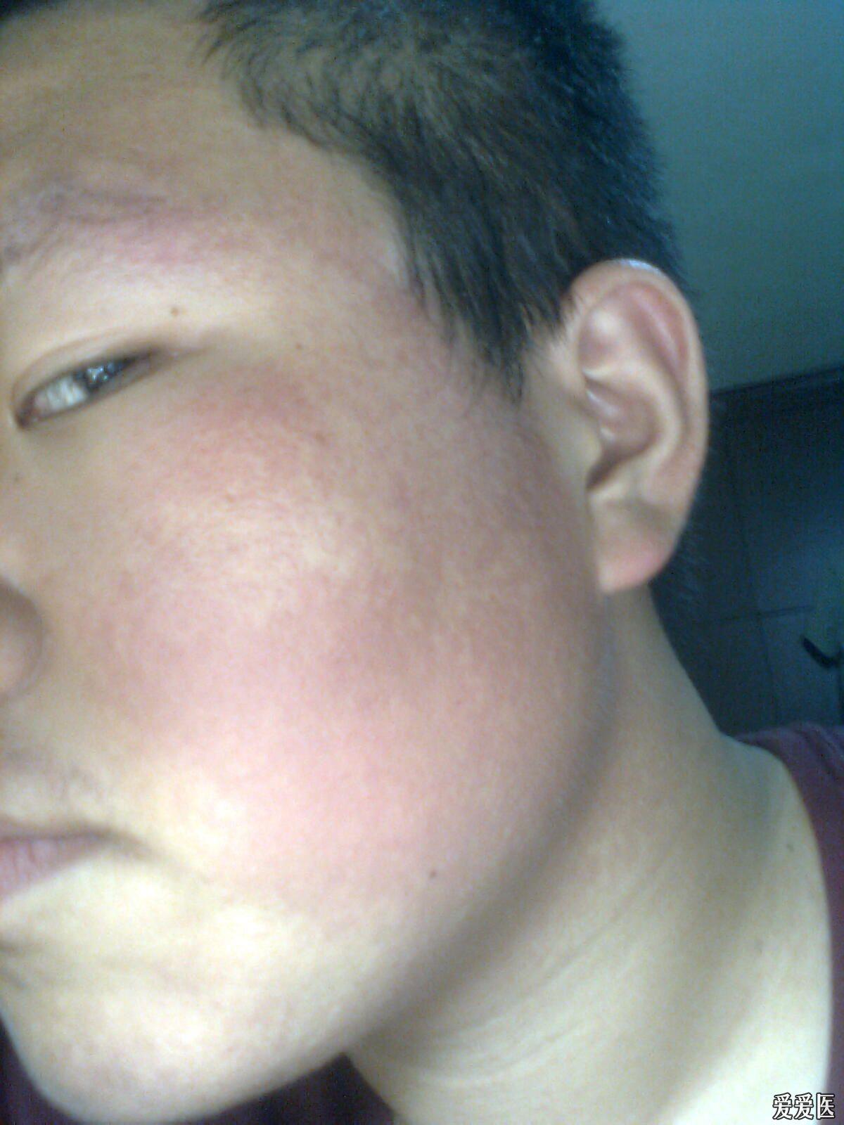 高手们我这是面颈部丘疹红斑黑变病还是红色毛发角化病啊激光能治好吗