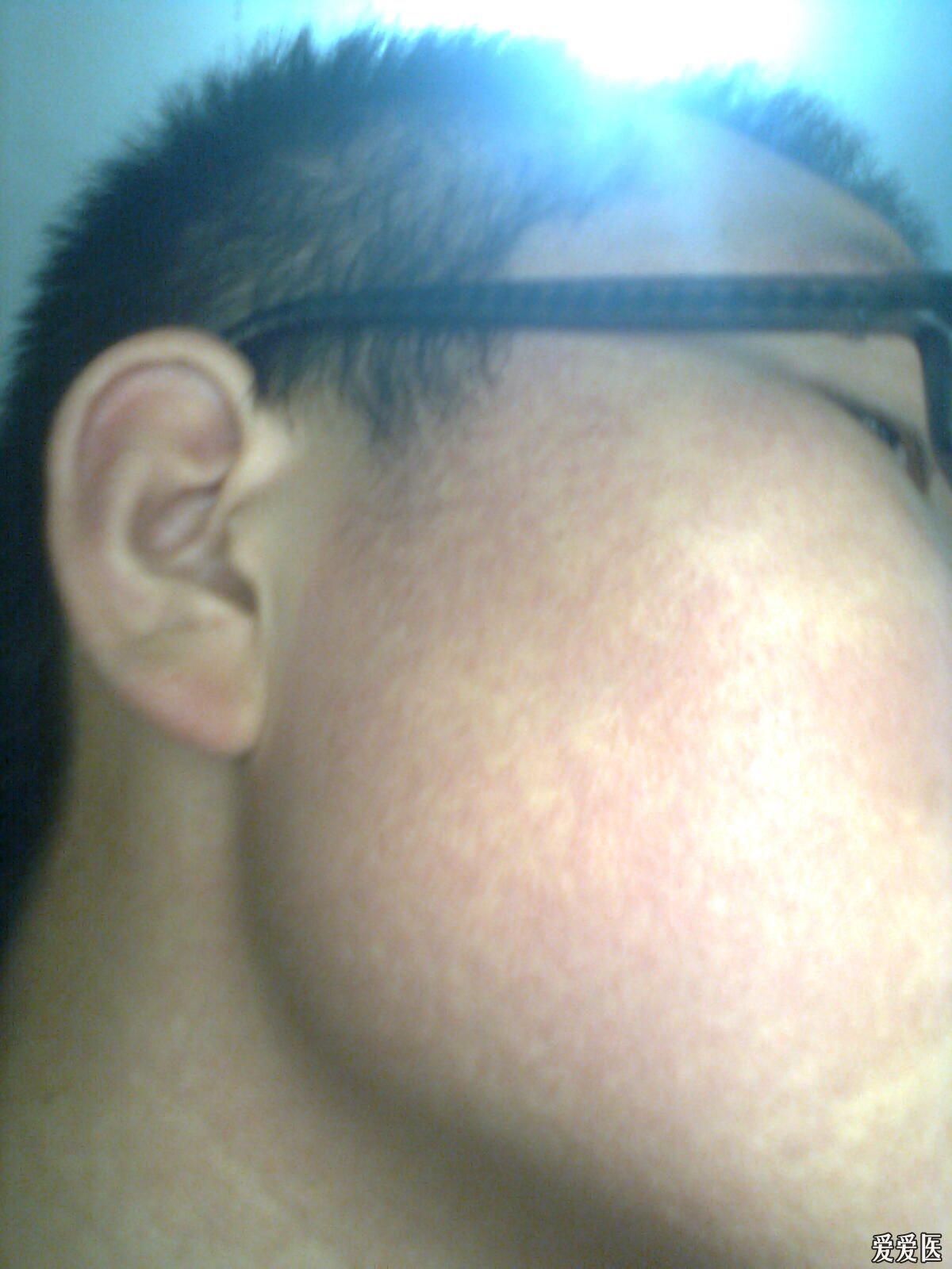 高手们我这是面颈部丘疹红斑黑变病还是红色毛发角化病啊激光能治好吗