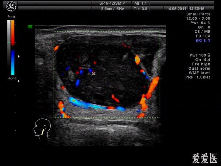 典型多形性腺瘤 超声医学讨论版 爱爱医医学论坛