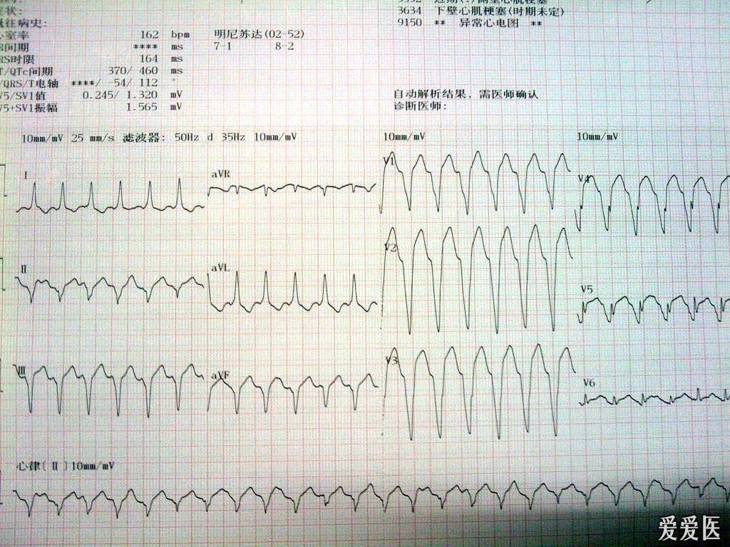 请教一份疑难心电图求正解!