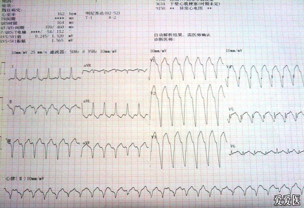 请教一份疑难心电图求正解