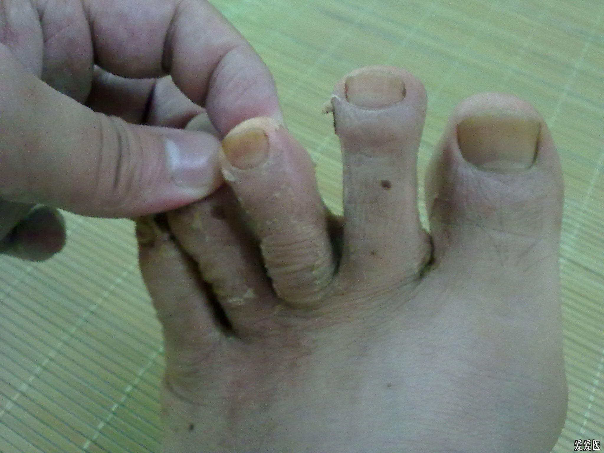 脚癣用药前后比较感谢中医小名