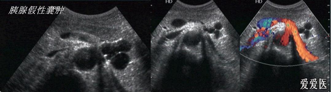 胰腺假性囊肿 - 超声医学讨论版 - 爱爱医医学论坛