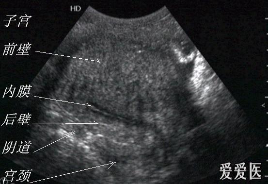 子宫腺肌症 超声医学讨论版 爱爱医医学论坛