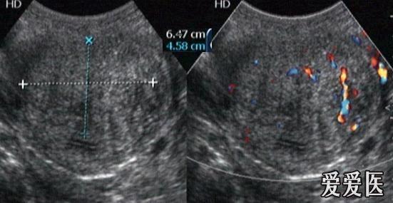 子宫腺肌症 - 超声医学讨论版 - 爱爱医医学论坛