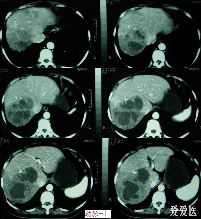 ct阅片:肝脏ct【结果已经公布】