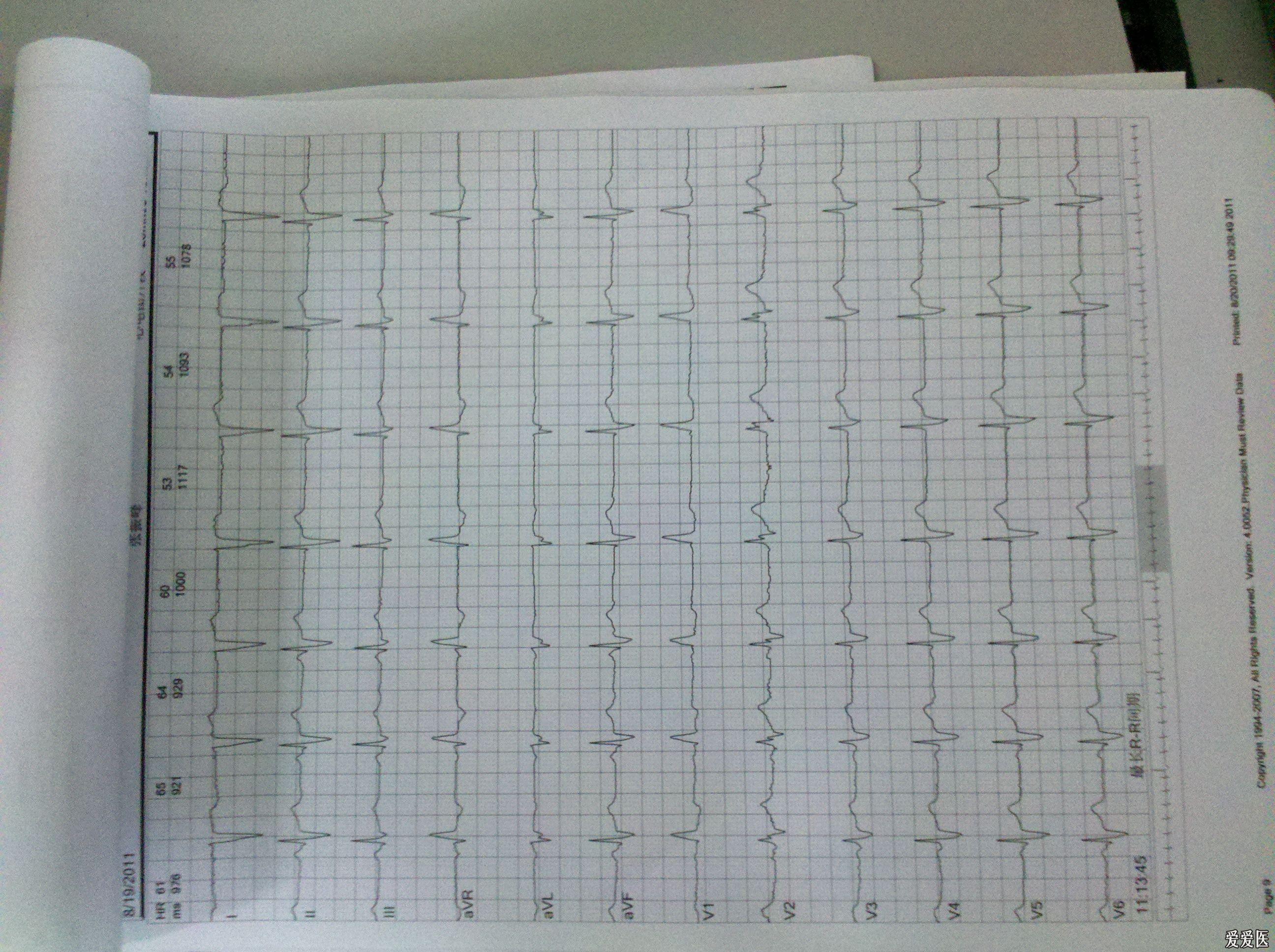 [其他] 发个心电图大家分析下