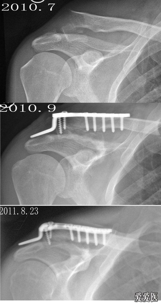 锁骨骨折术后 - 医学影像学讨论版 - 爱爱医医学论坛