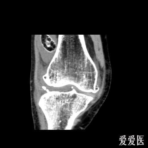 右侧股骨下端滑膜骨软骨瘤病