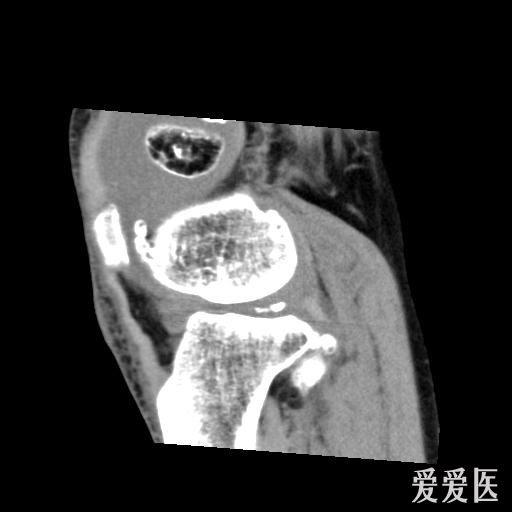 右侧股骨下端滑膜骨软骨瘤病?