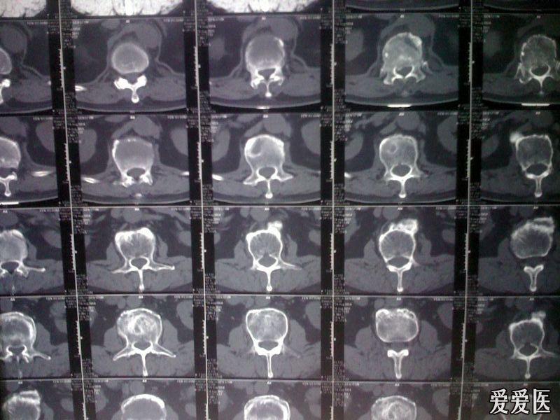 看看这个t12椎体骨折并椎管狭窄