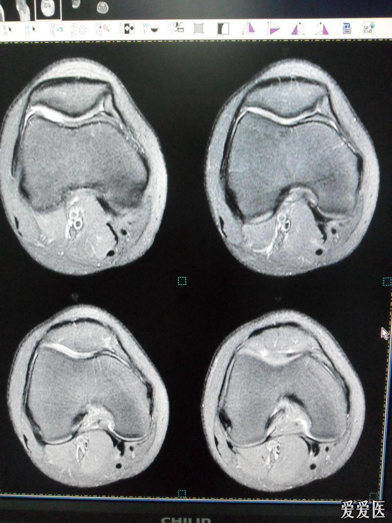 膝关节外伤mri检查,注意观察半月板 - 医学影像学讨论