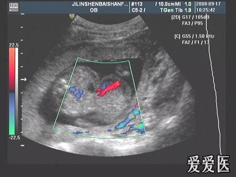 胎儿腹部包块考虑什么呢? - 超声医学讨论版 - 爱爱医