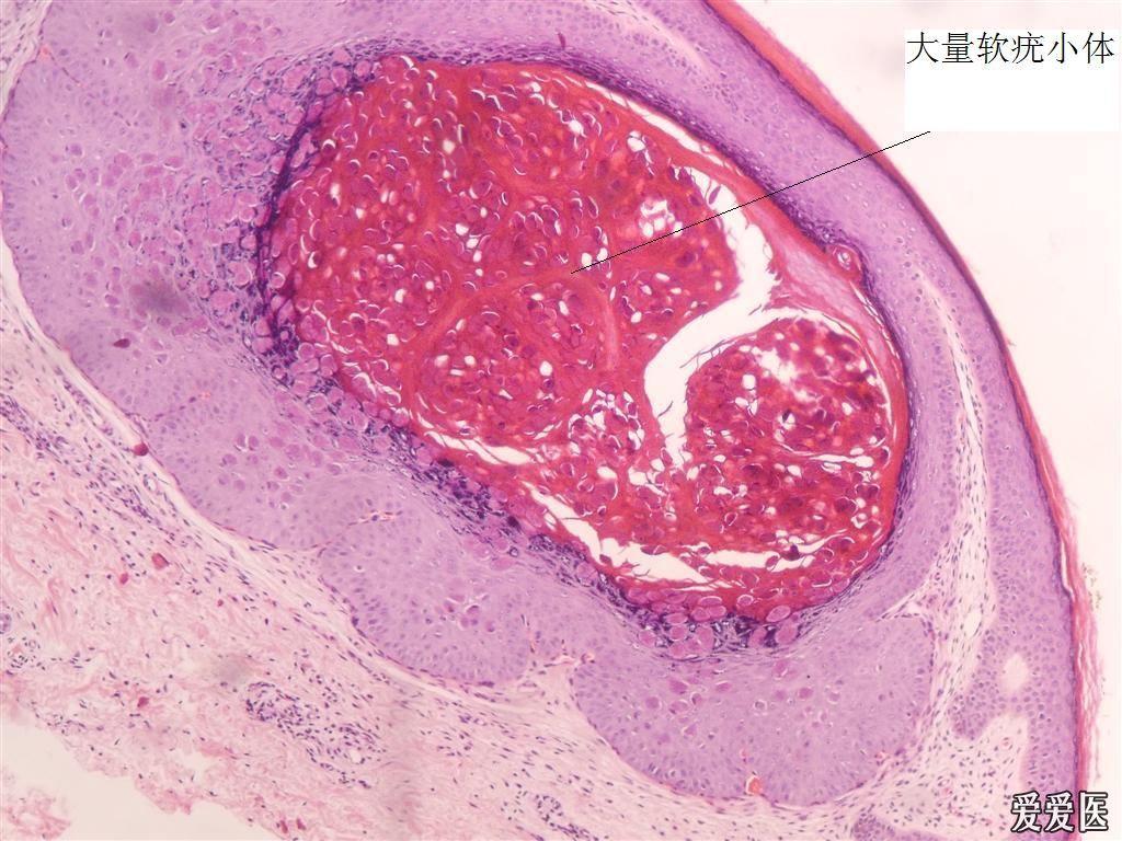 传染性软疣(附有病理)