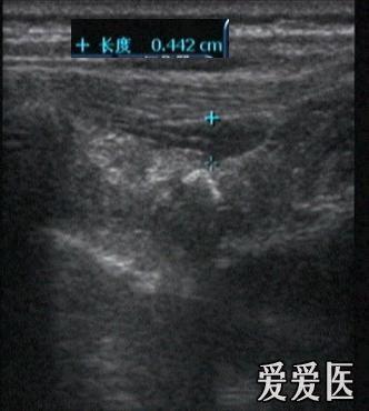 骨膜软骨瘤吗? - 超声医学讨论版 - 爱爱医医学论坛