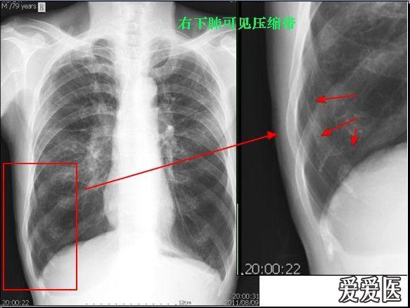 此次发病突发呼吸困难5小时,胸片除肺气肿和肺大泡外,右下肺可见气胸
