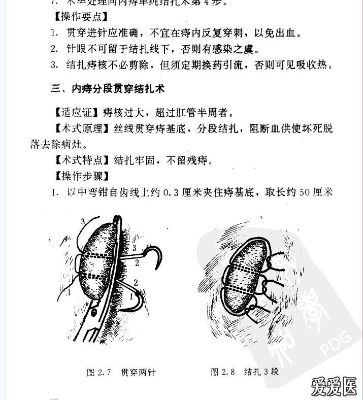 严重三期混合痔术前术后图片欣赏第八例