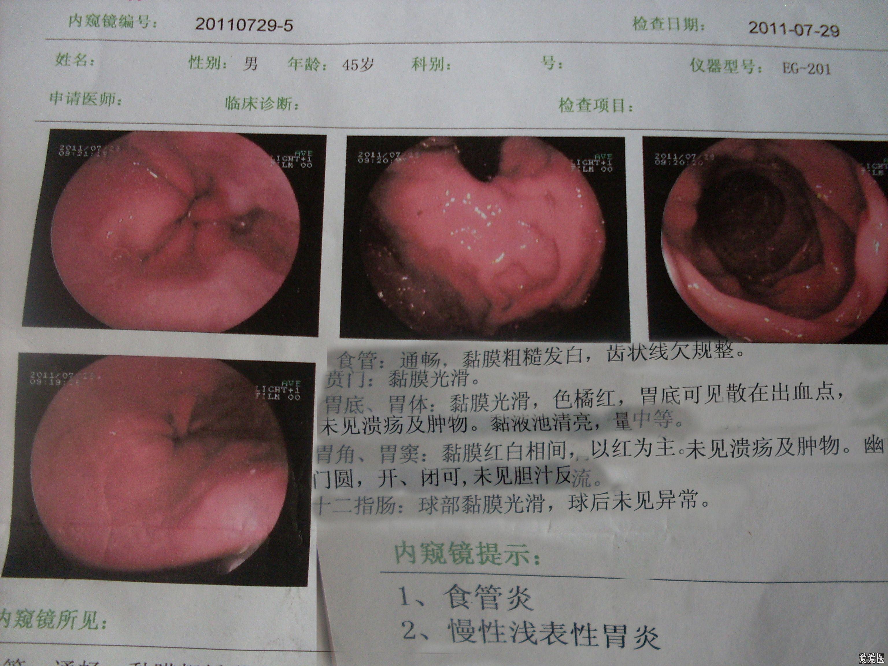 持续性剑突至喉部"发热"及喉部堵塞感伴剑突下阵发性隐痛8个月