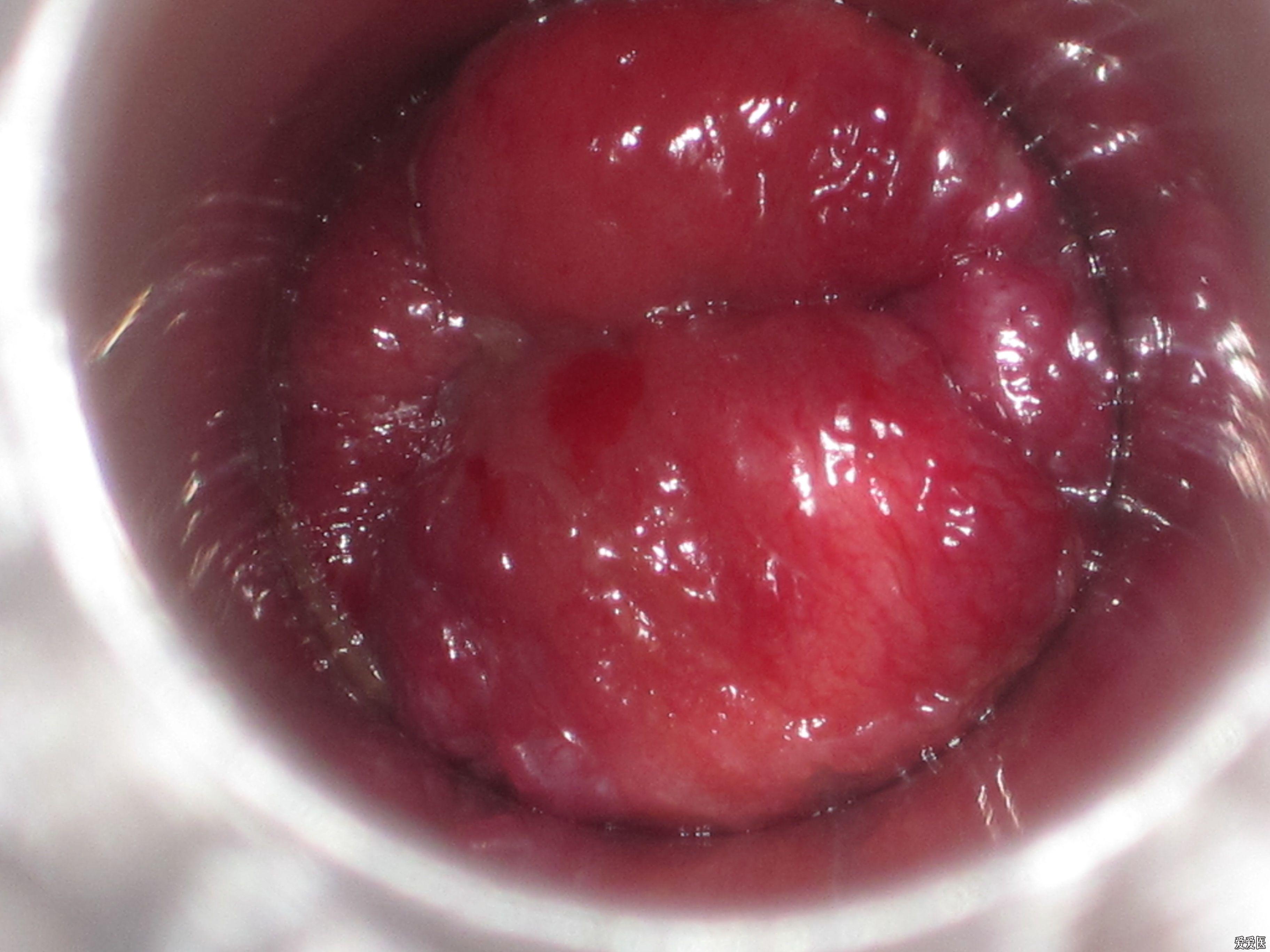 三期环状结缔组织性混合痔术前术后图片欣赏第七例