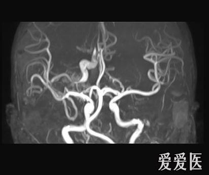 典型脑血管畸形-mri,mra,dsa