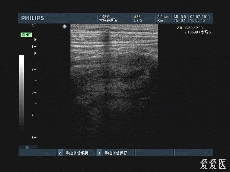 典型阑尾炎图片 - 超声医学讨论版 - 爱爱医医学论坛