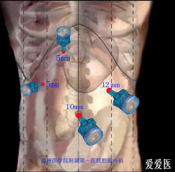 腹腔镜胆总管囊肿trocar图.jpg