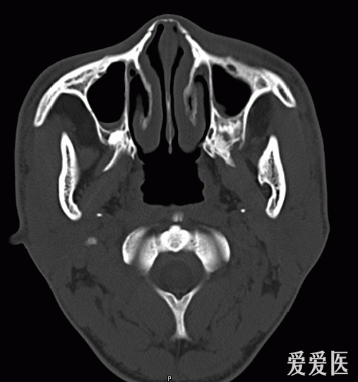 鼻骨骨折