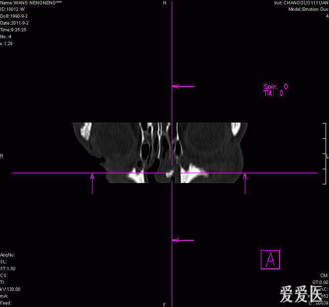 鼻骨骨折