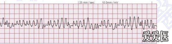 呼吸版经验交流(2)呼吸科医生学心电图——看图识字 ecg