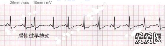 呼吸版经验交流(2)呼吸科医生学心电图——看图识字 ecg