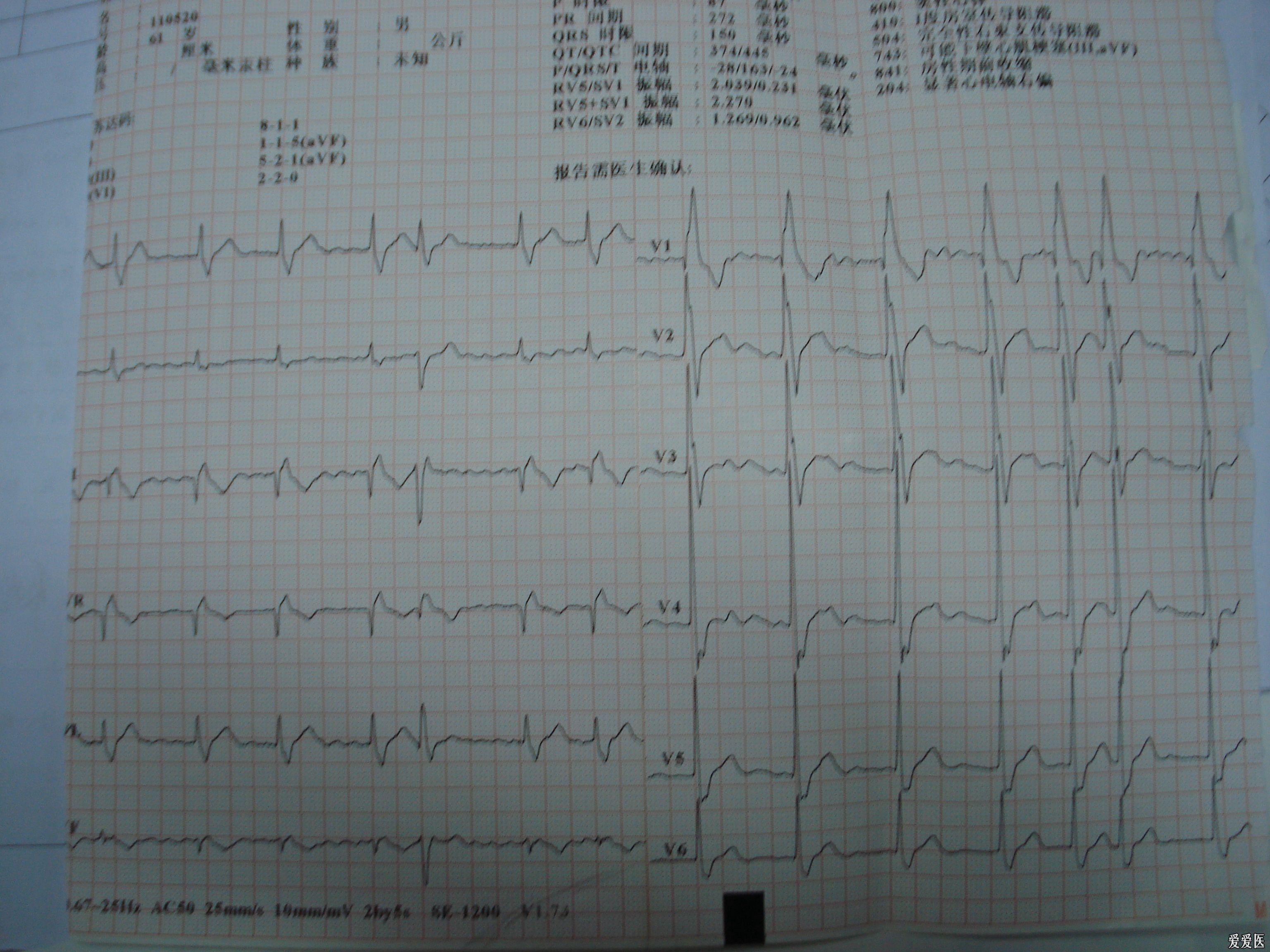 [心电图分析] 请老师帮忙看看心电图,是房颤么?