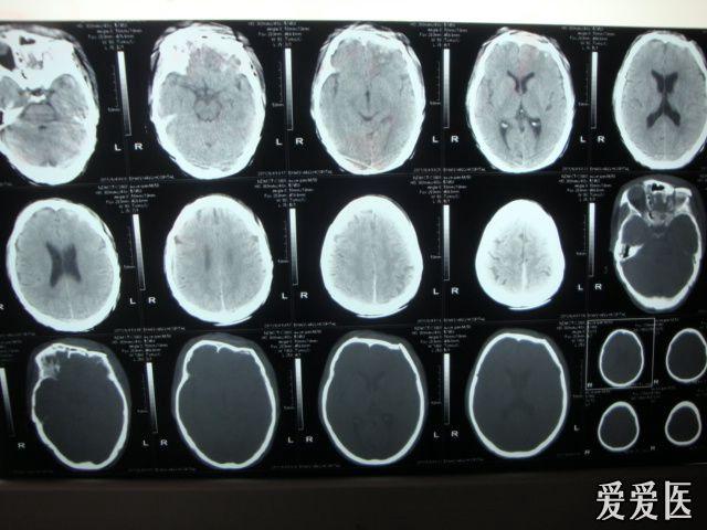 一例额骨凹陷性骨折合并窦缓是否手术治疗