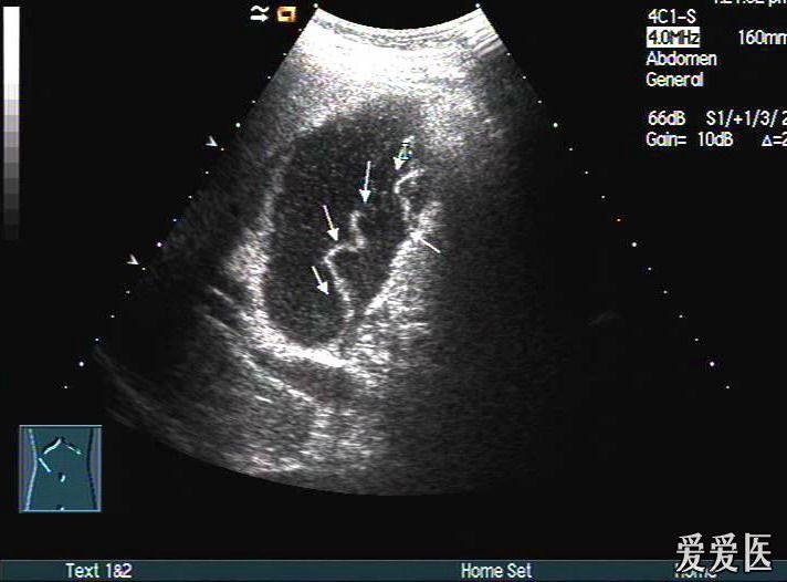 考虑急性坏疽性胆囊炎伴穿孔可能——zengerya - 超声