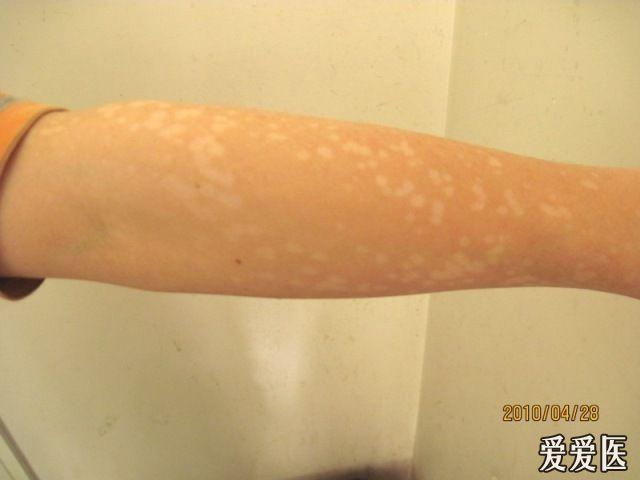 典型病例展示10—花斑癣样白斑
