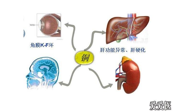 肝豆状核变性曾经误诊过的未误诊过的都请进