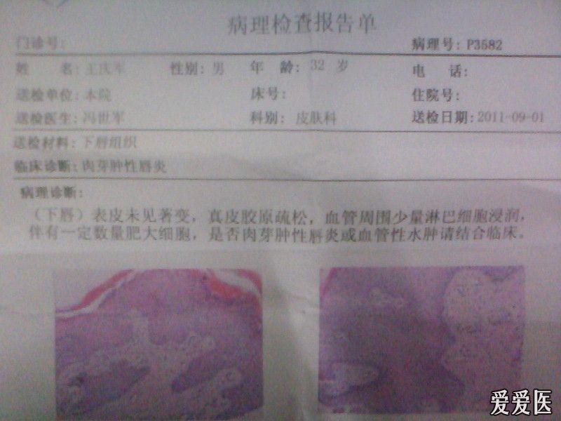 临床诊断肉芽肿性唇炎 - 皮肤及性传播疾病讨论版