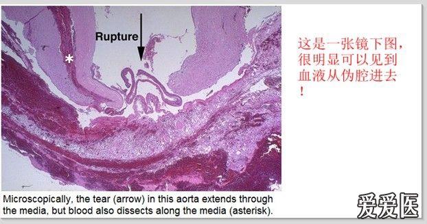 如何鉴别主动脉夹层和ami,临床上致命的失误!
