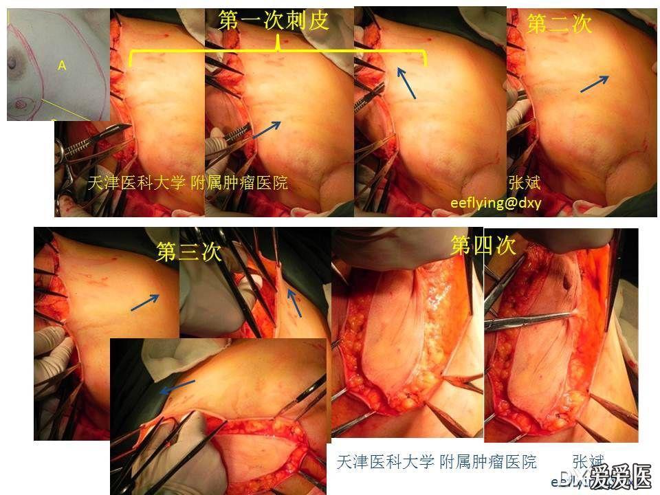 eeflying贴一个乳腺癌手术的图片