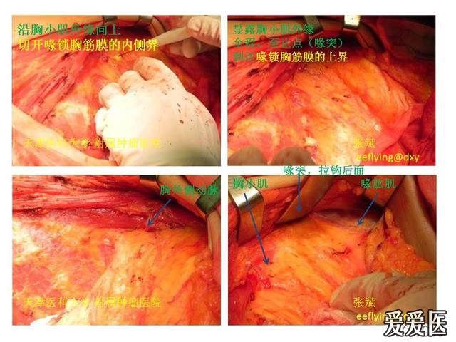eeflying贴一个乳腺癌手术的图片