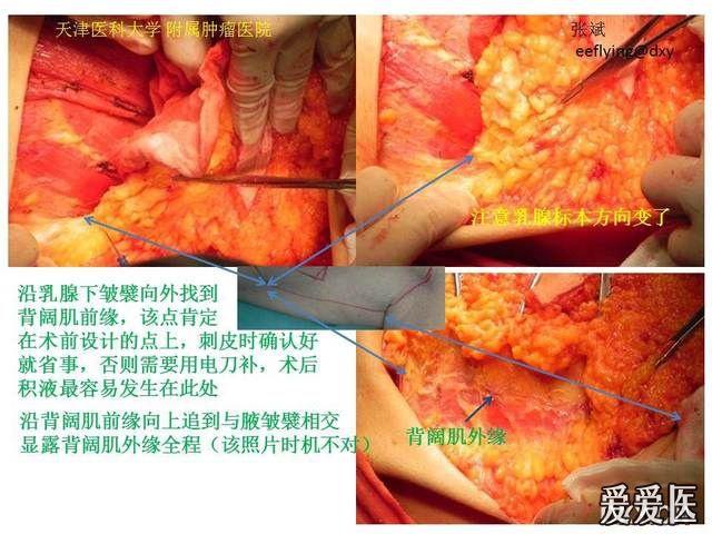 eeflying贴一个乳腺癌手术的图片