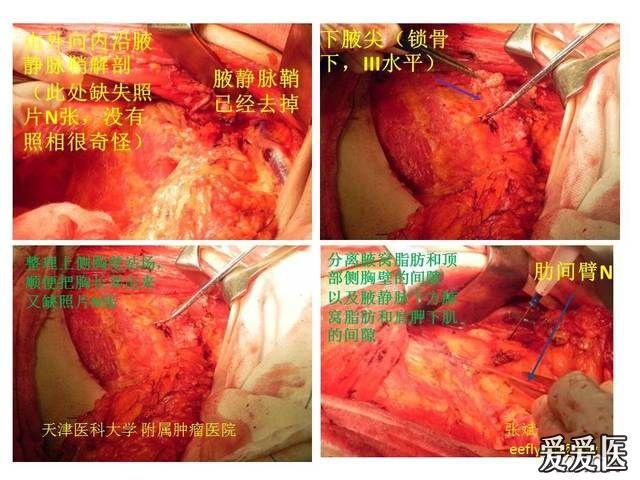eeflying贴一个乳腺癌手术的图片