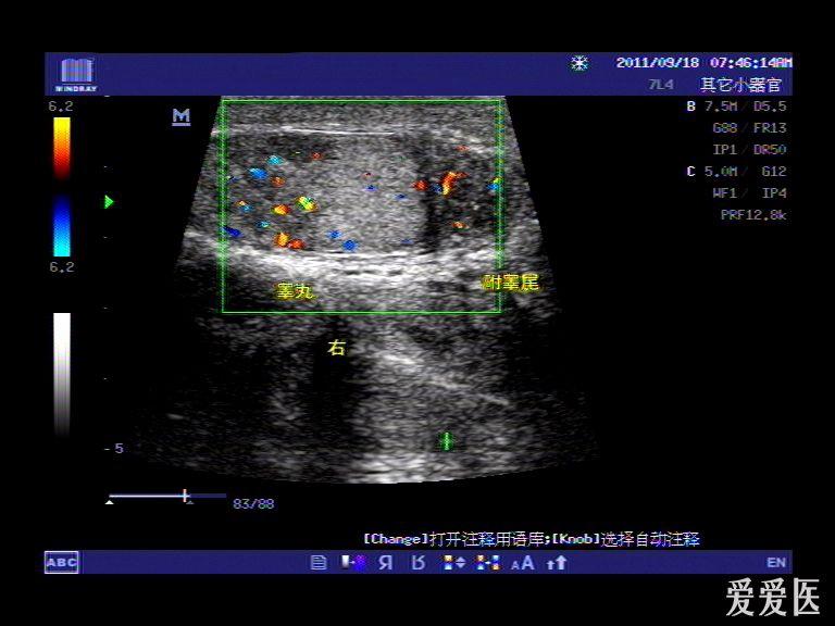 右睾丸附睾炎,附睾头囊肿 - 超声医学讨论版 - 爱爱医