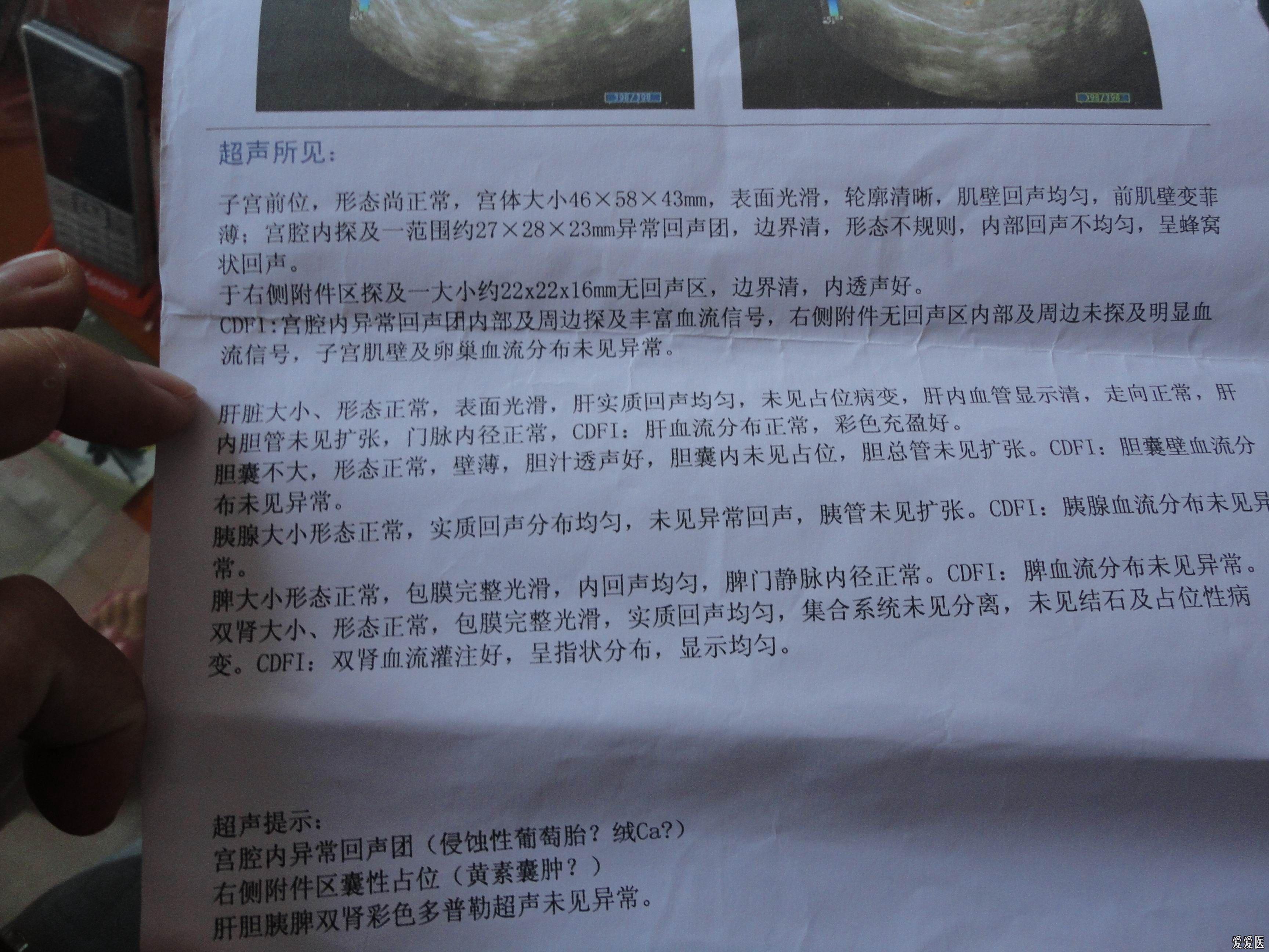这个是葡萄胎吗